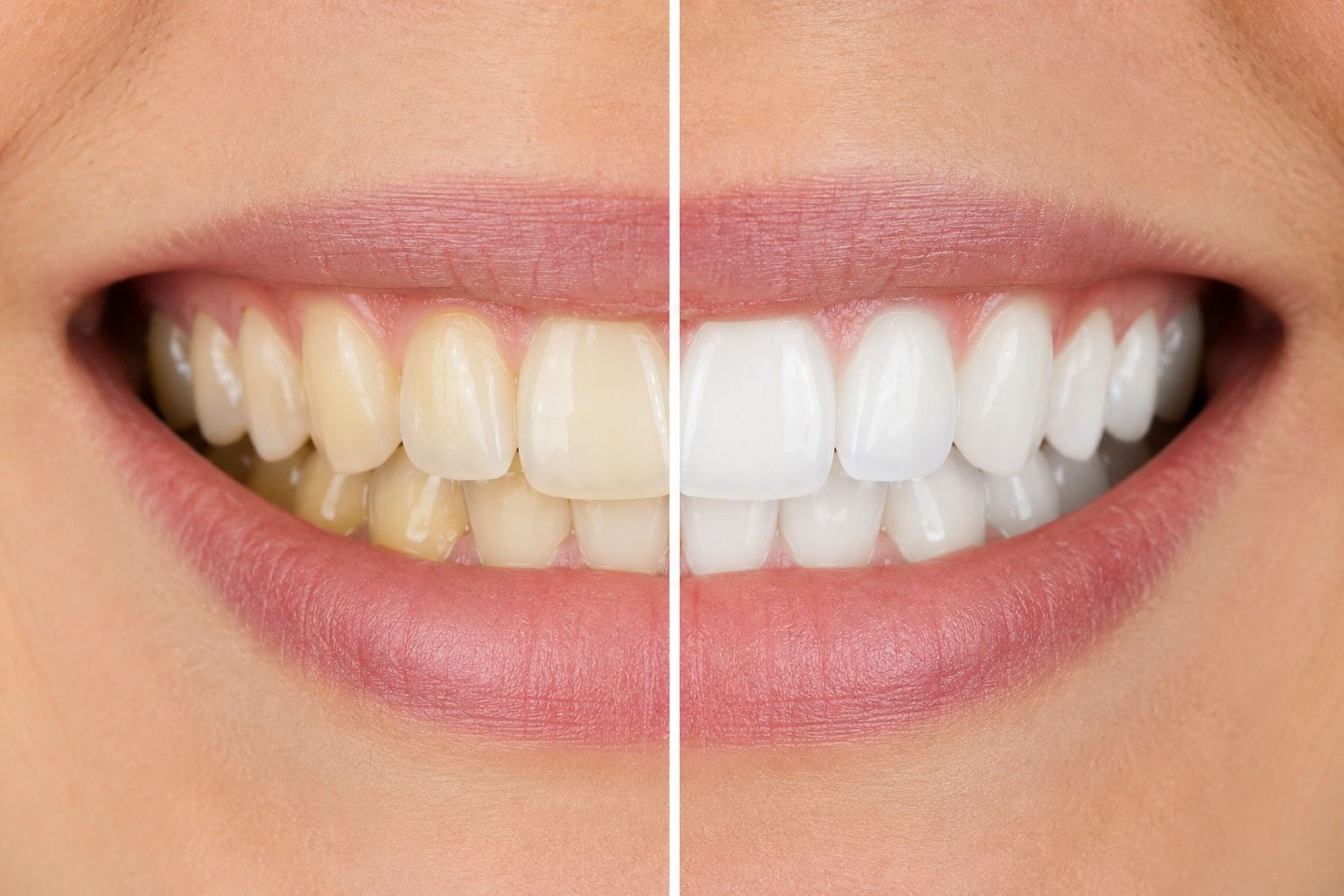 Clareamento Dentário