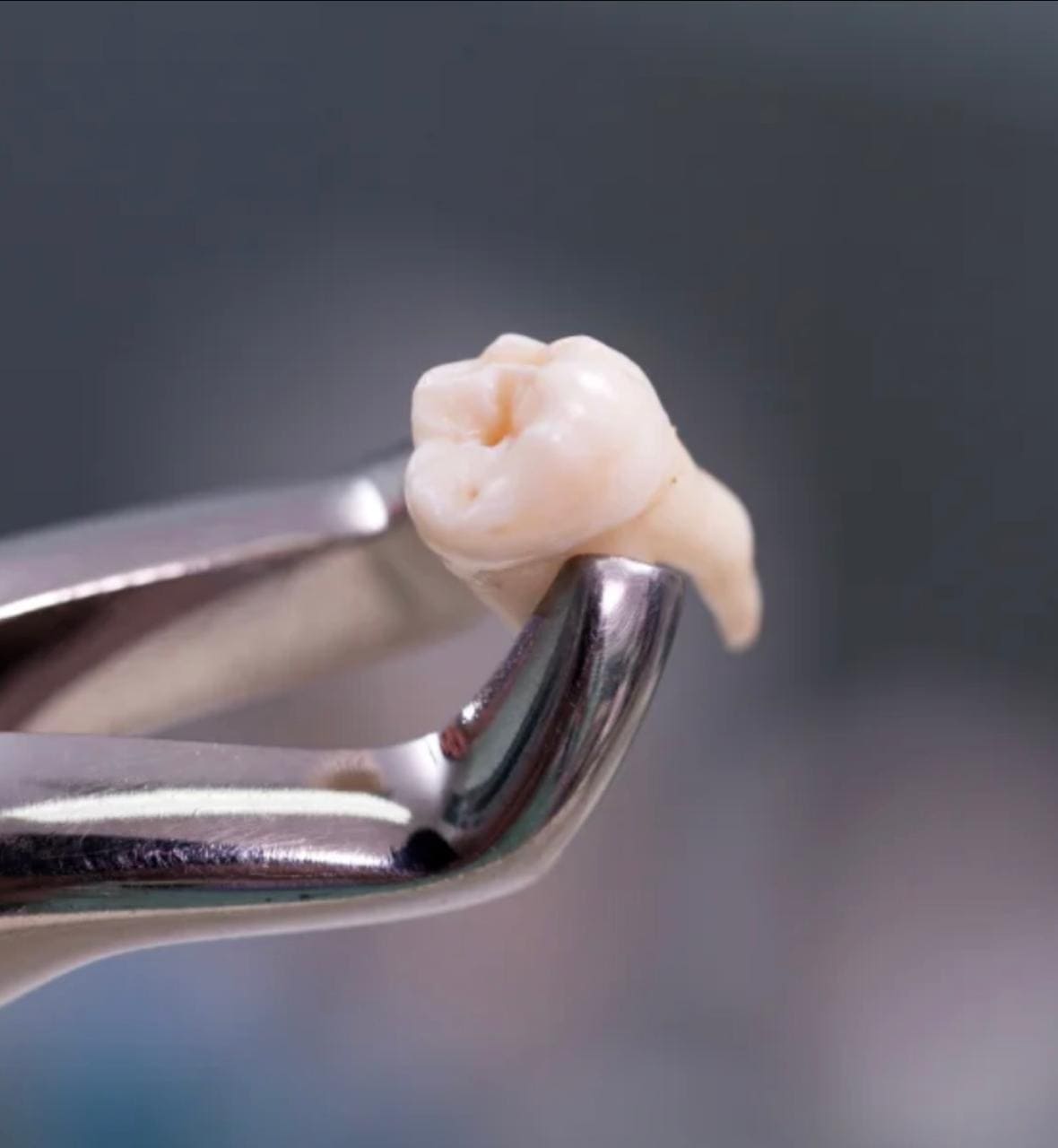 Extrações Dentárias