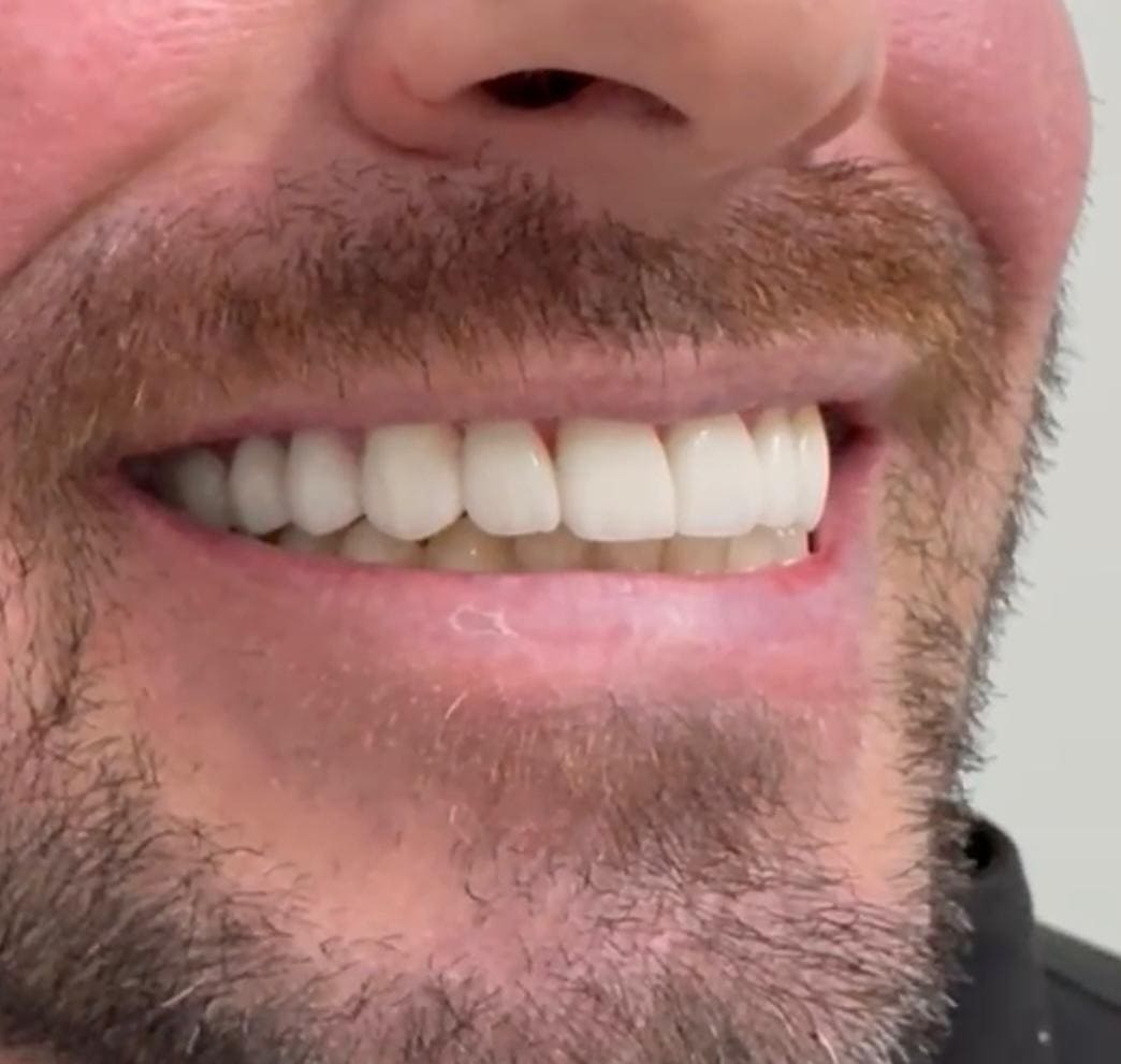 Facetas Dentárias
