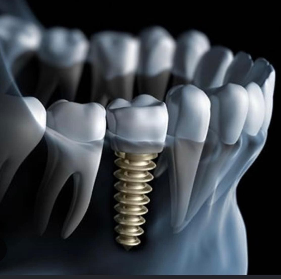 Implantes Dentários