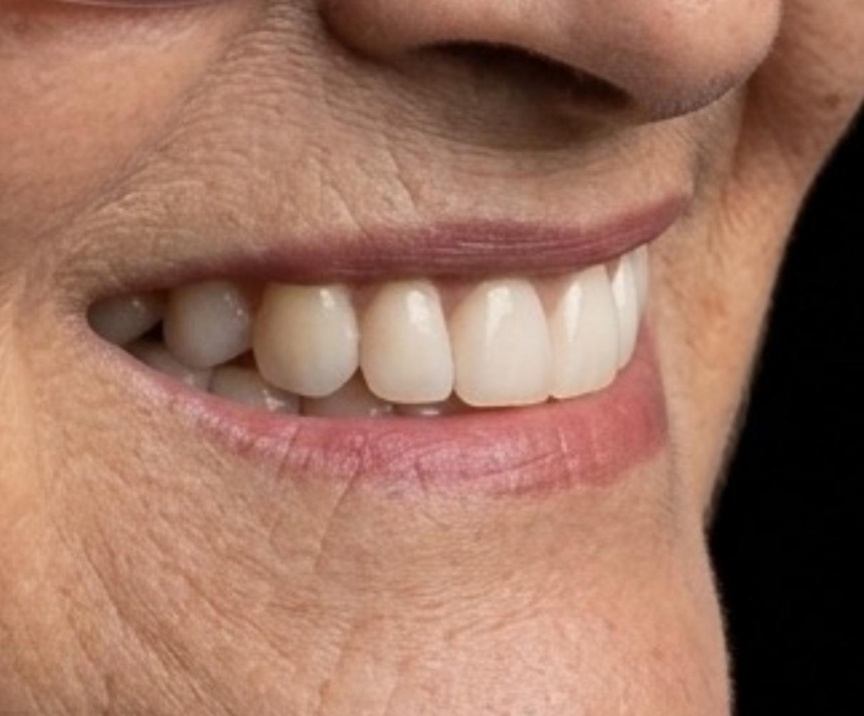 Prótese Dentária