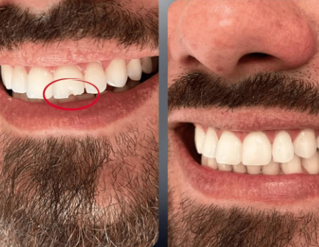 Restauração Dentária